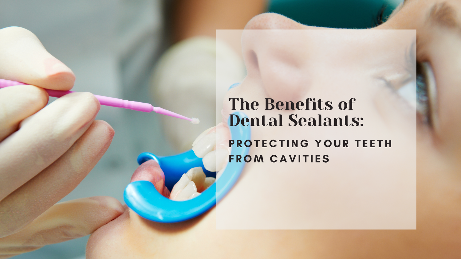 Featured image for Exploring the Benefits of Dental Sealants: Protecting Teeth from Cavities