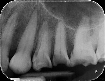 Featured image for Protecting Your Teeth from Acid Erosion: Dietary Tips and Preventive Measures
