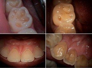 Content image for Protecting Your Teeth from Acid Erosion: Dietary Tips and Preventive Measures