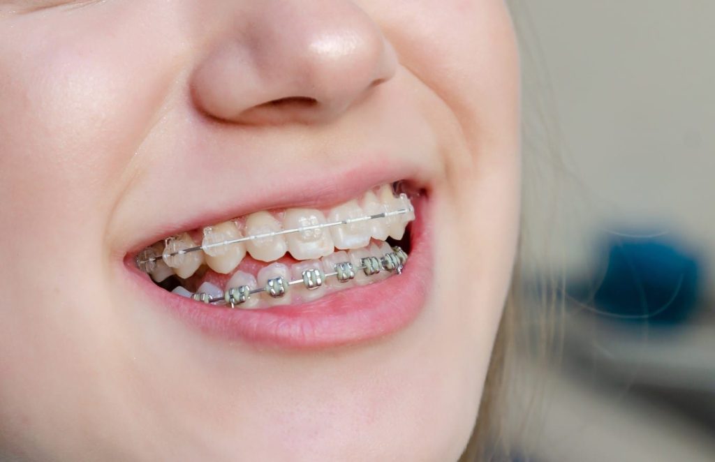Content image for The Importance of Early Orthodontic Intervention: Correcting Bite Issues in Children