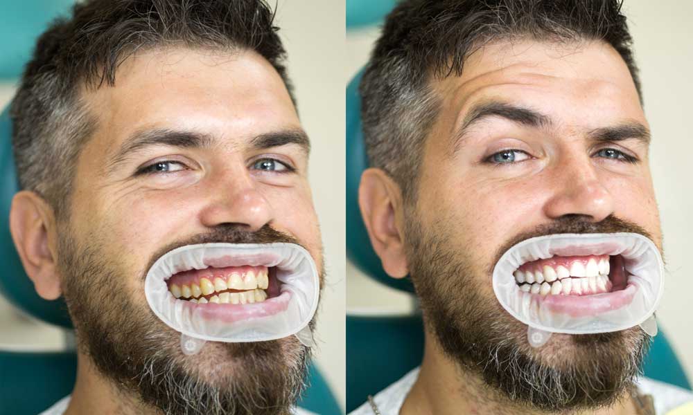 Content image for Effective Strategies for Teeth Whitening: Safe and Effective Home and Professional Options