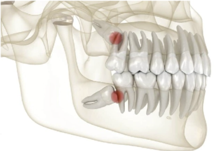 Featured image for Decoding the Mysteries of Wisdom Teeth: Extraction and Post-Operative Care