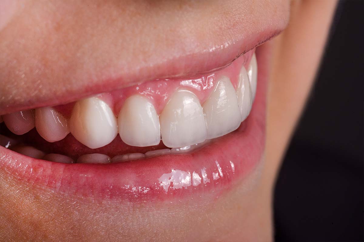 Featured image for Exploring the Benefits of Dental Veneers: Achieving a Perfect Smile and Confidence