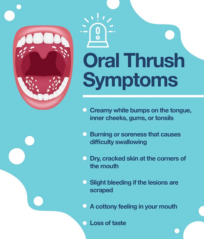 Content image for Preventing and Managing Oral Thrush: Causes, Symptoms, and Treatment Options