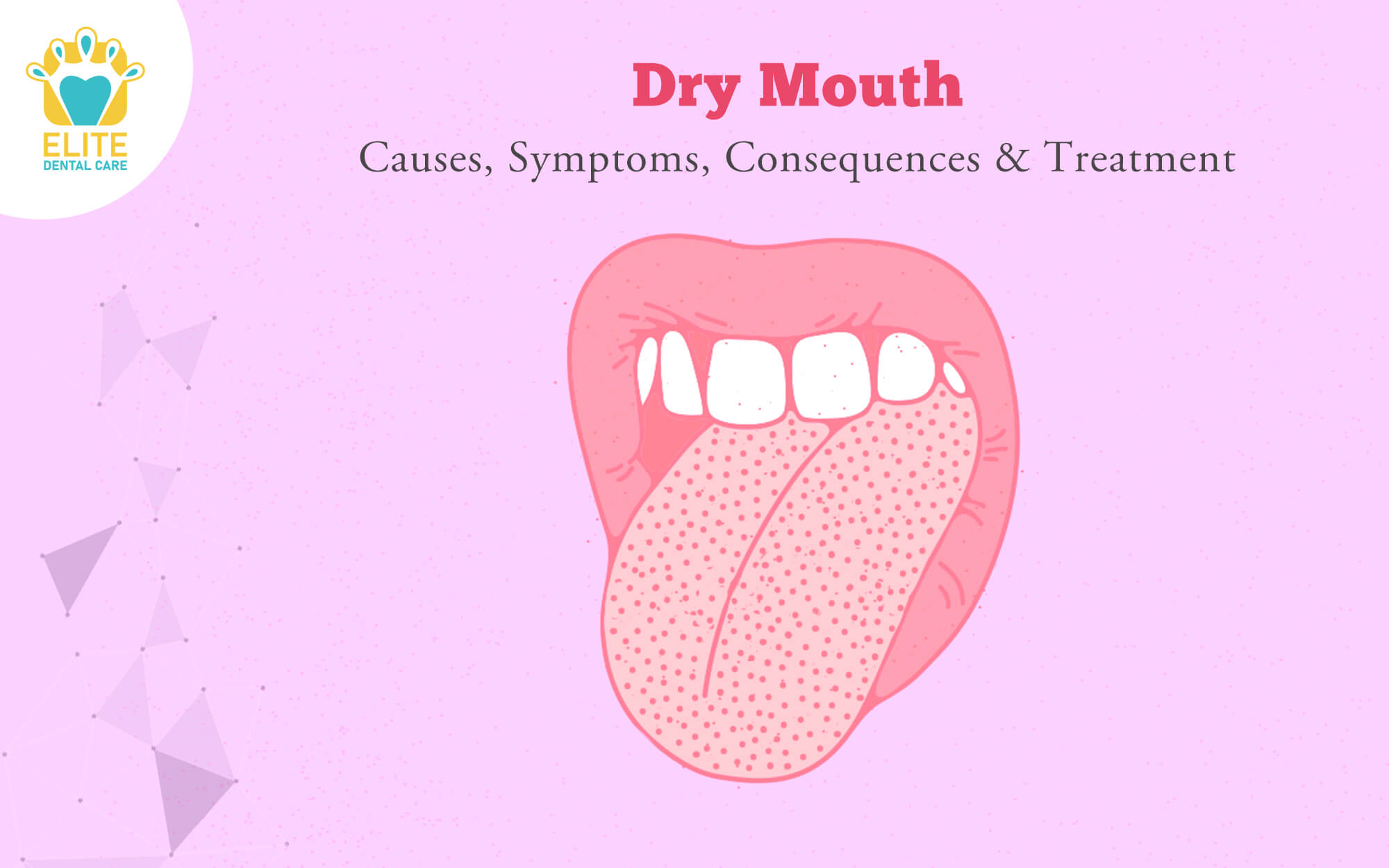 Featured image for Understanding and Managing Dry Mouth: Causes, Symptoms, and Treatment