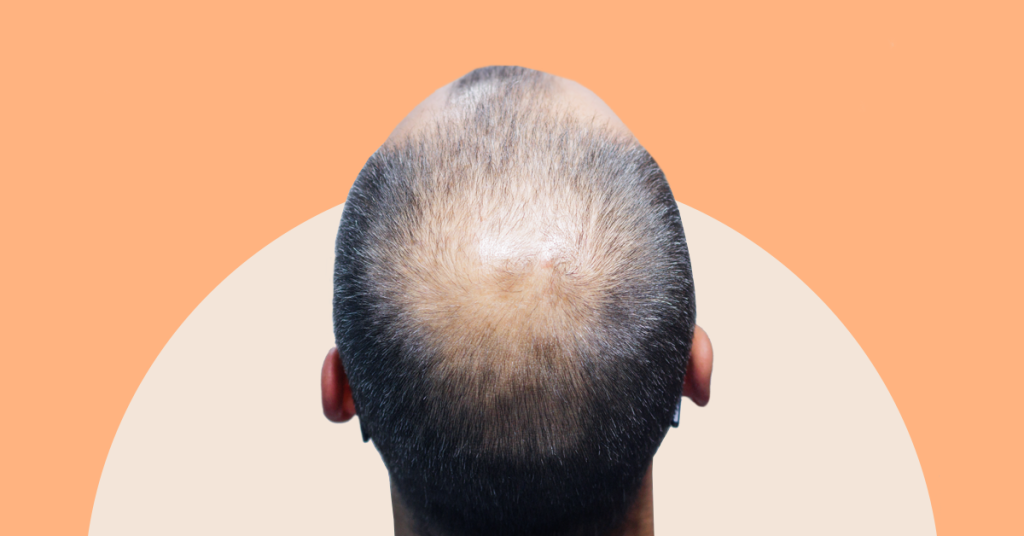 Content image for Understanding the Complexities of Androgenetic Alopecia: Causes and Treatments