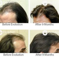 Content image for Navigating the Challenges of Telogen Effluvium: Stress and Hair Shedding