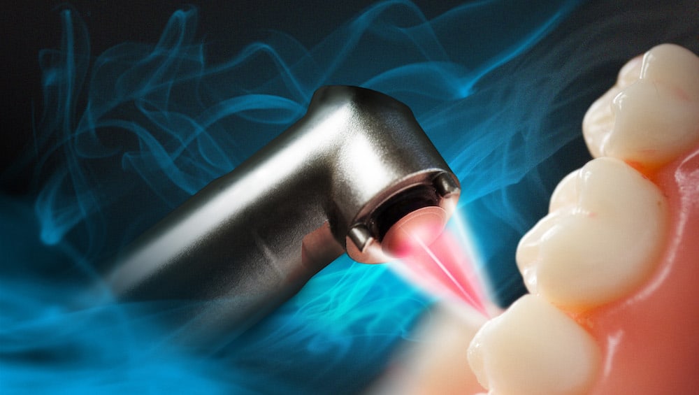 Content image for Exploring the Benefits of Laser Dentistry: Minimally Invasive Procedures