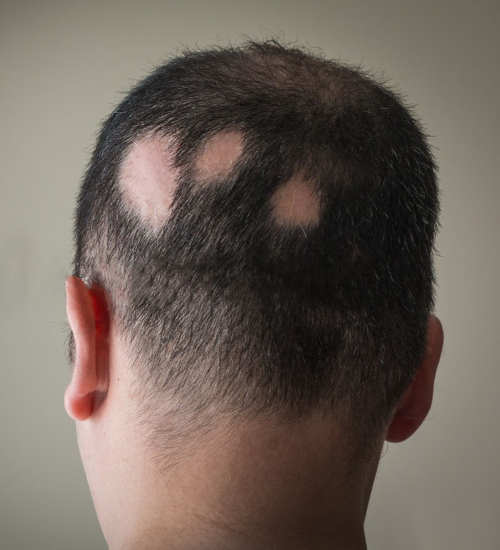 Featured image for Demystifying Alopecia Areata: Exploring Autoimmune Causes and Therapies