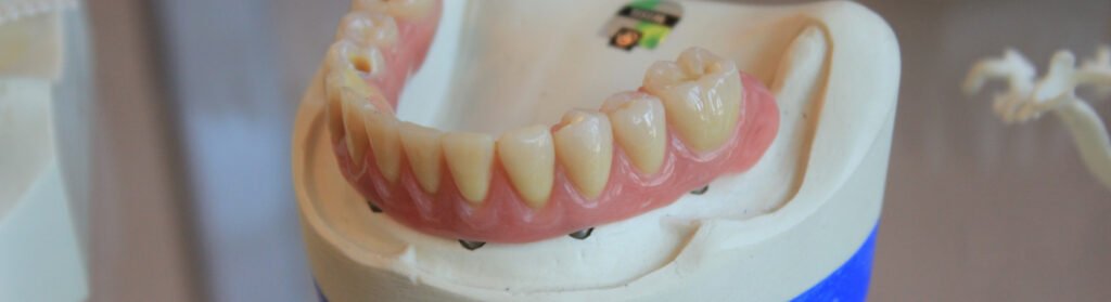 Content image for The Essential Guide to Caring for Dental Bridges: Maintaining Hygiene and Function