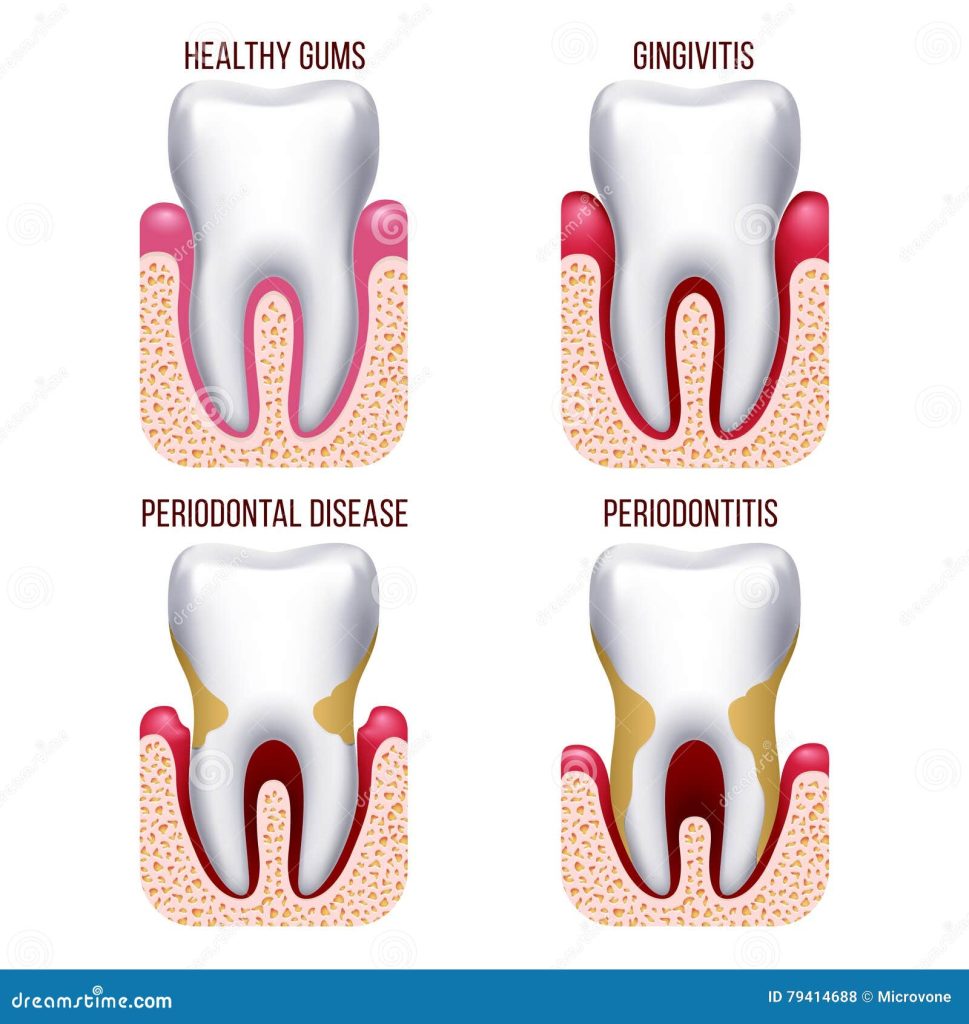 Content image for The Impact of Stress on Oral Health: Bruxism, Gum Disease, and Prevention