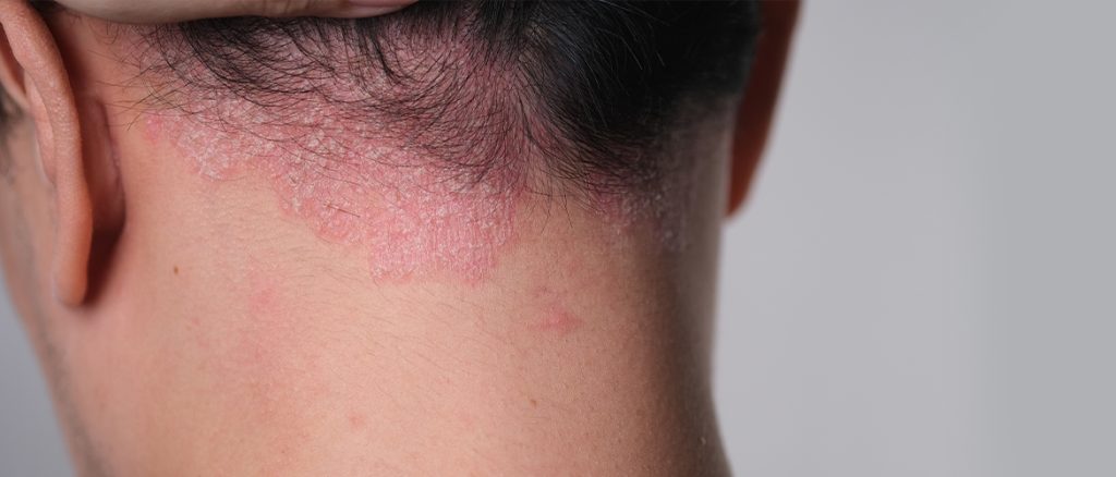 Content image for Recognizing and Addressing Hair Loss from Scalp Infections: Fungal and Bacterial