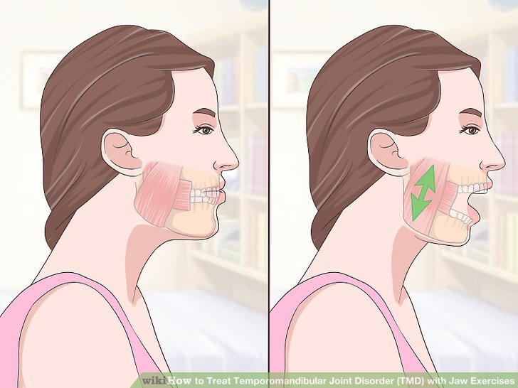 Content image for Decoding the Mysteries of TMJ Disorders: Physiotherapy for Jaw Pain Relief