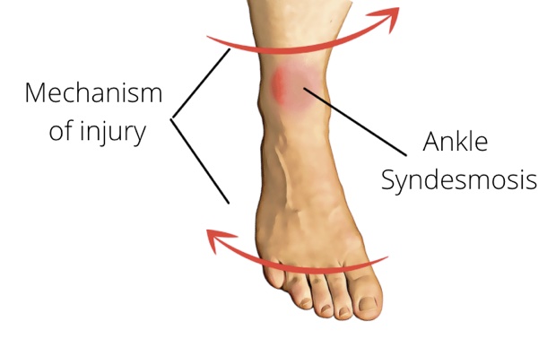 Content image for Understanding and Treating Common Ankle Sprains: Physiotherapy Rehabilitation