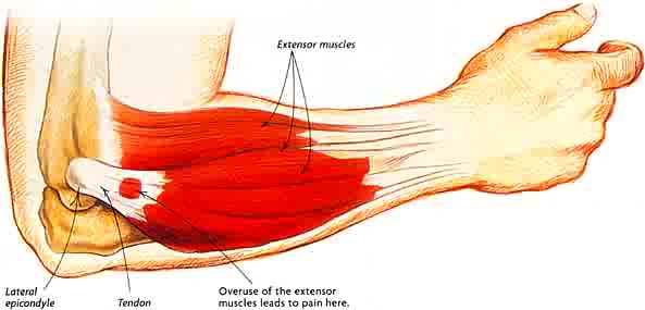 Featured image for Understanding and Managing Tennis Elbow: Physiotherapy Treatment and Tips