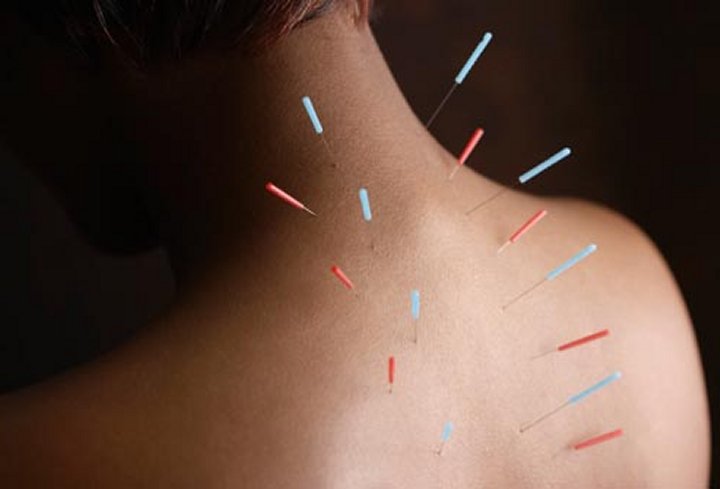 Featured image for Combating Chronic Pain with Alternative Treatments: Acupuncture and Massage