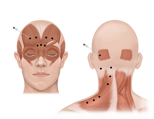 Featured image for Managing Migraines with Botulinum Toxin Injections and Nerve Blocks
