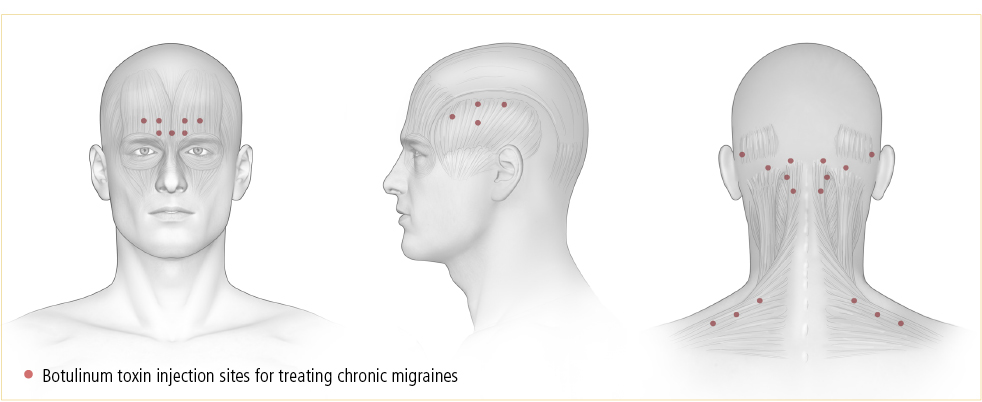 Content image for Managing Migraines with Botulinum Toxin Injections and Nerve Blocks