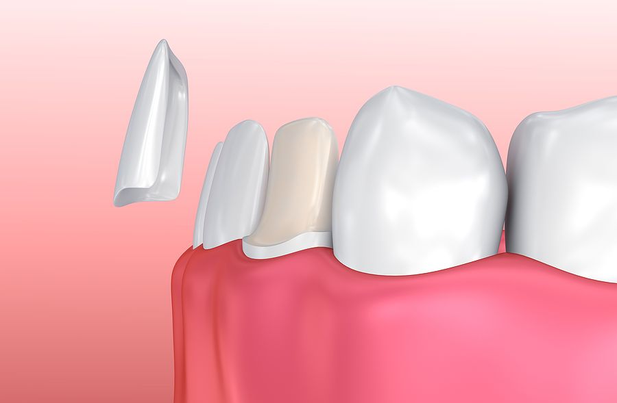Featured image for The Importance of Dental Treatments: Root Canals, Crowns, and Implants