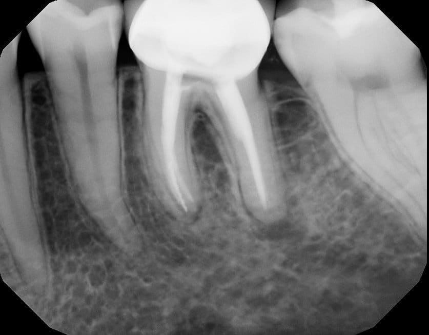Content image for The Importance of Dental Treatments: Root Canals, Crowns, and Implants