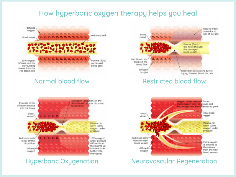 Content image for Exploring the Benefits of Hyperbaric Oxygen Therapy: Wound Healing and Infections