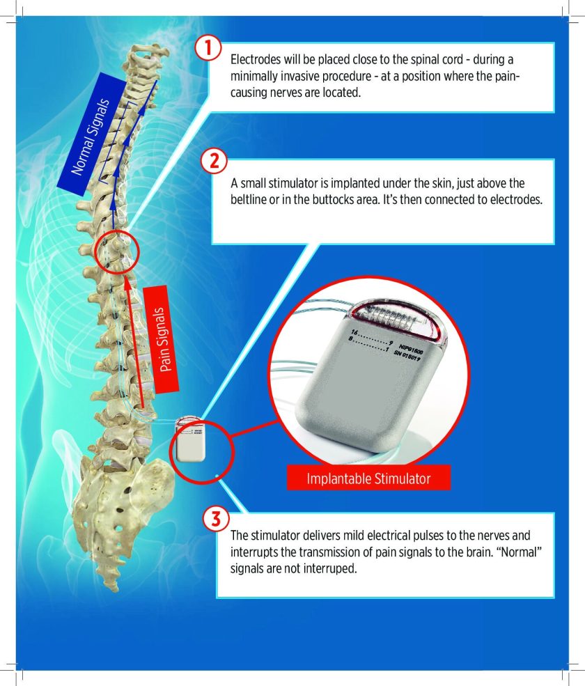 Featured image for Preventing and Managing Back Pain with Spinal Cord Stimulation and Injections