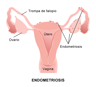 Featured image for The Essential Guide to Women's Health Treatments: Hysterectomy and Endometriosis