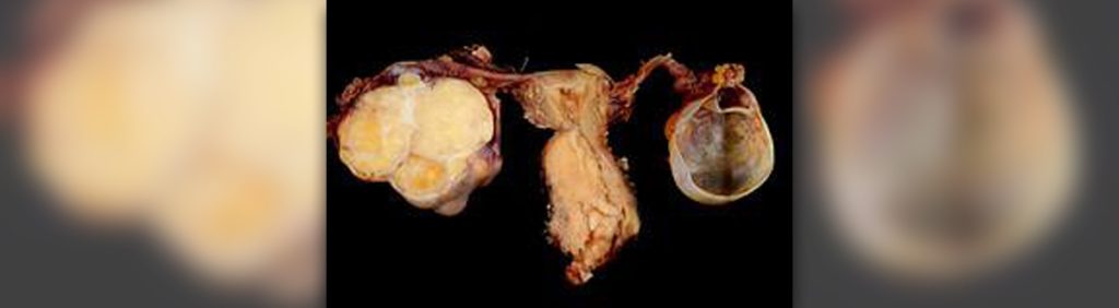 Content image for The Essential Guide to Women's Health Treatments: Hysterectomy and Endometriosis