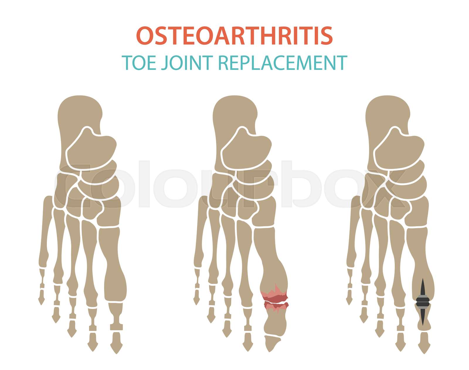 Featured image for Understanding and Managing Arthritis with Joint Replacement Surgery