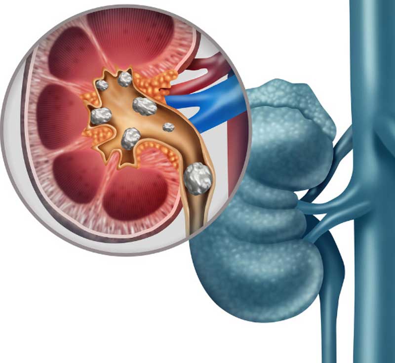 Featured image for The Importance of Kidney Treatments: Lithotripsy and Kidney Transplant
