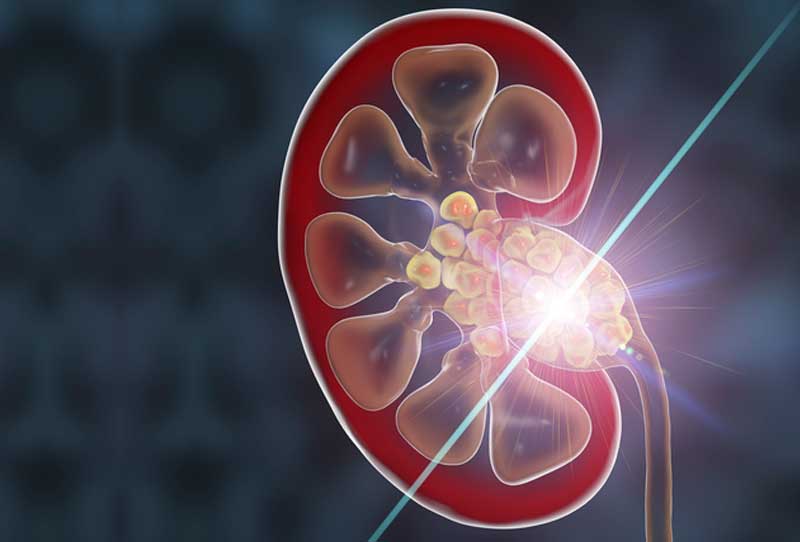 Content image for The Importance of Kidney Treatments: Lithotripsy and Kidney Transplant