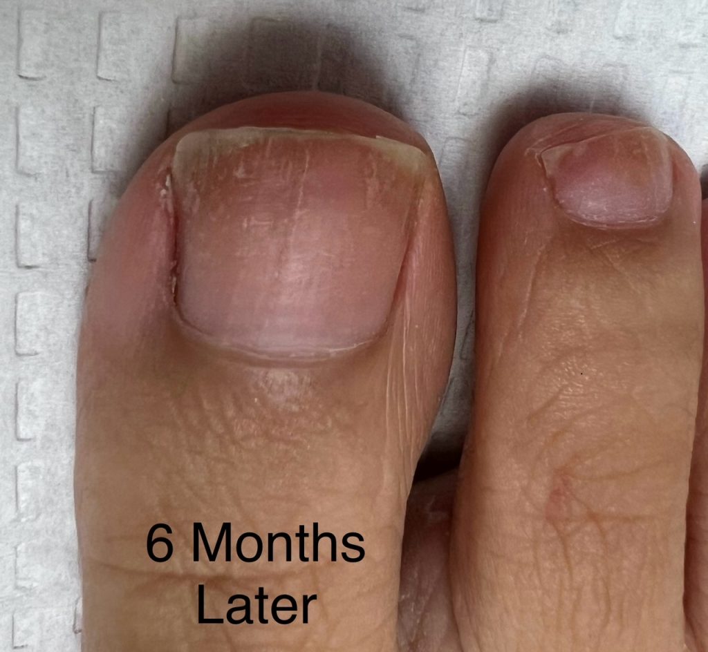 Content image for Understanding and Treating Common Nail Problems with Laser Treatments